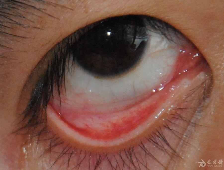 角膜炎的早期症状图片