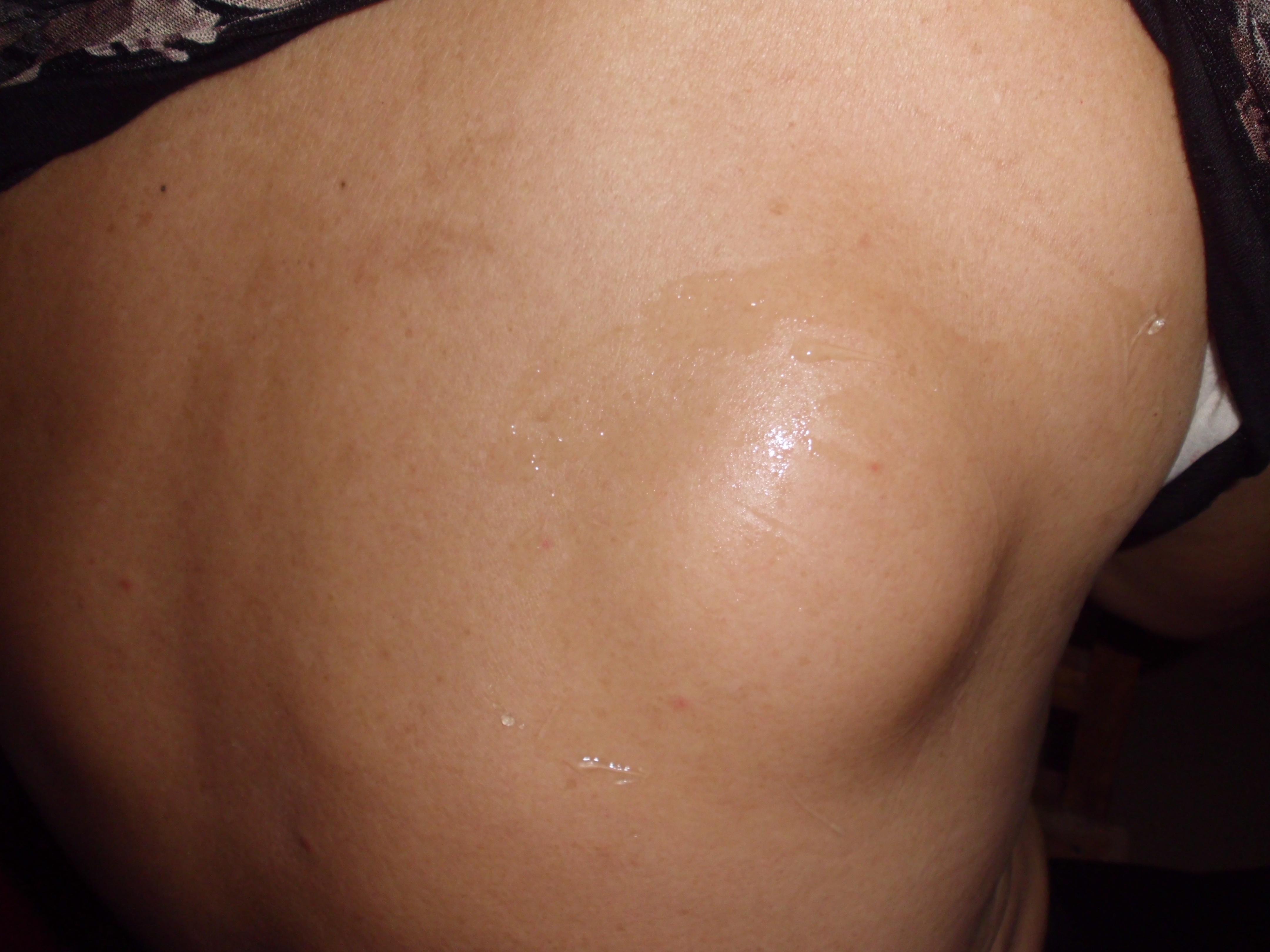 背后脂肪瘤图片图片