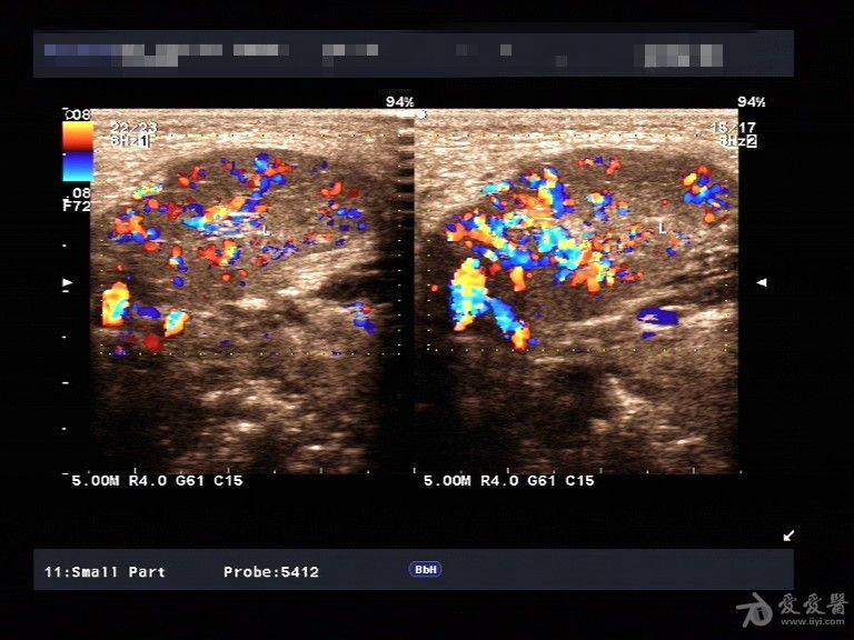 急性腮腺炎的超声图片图片