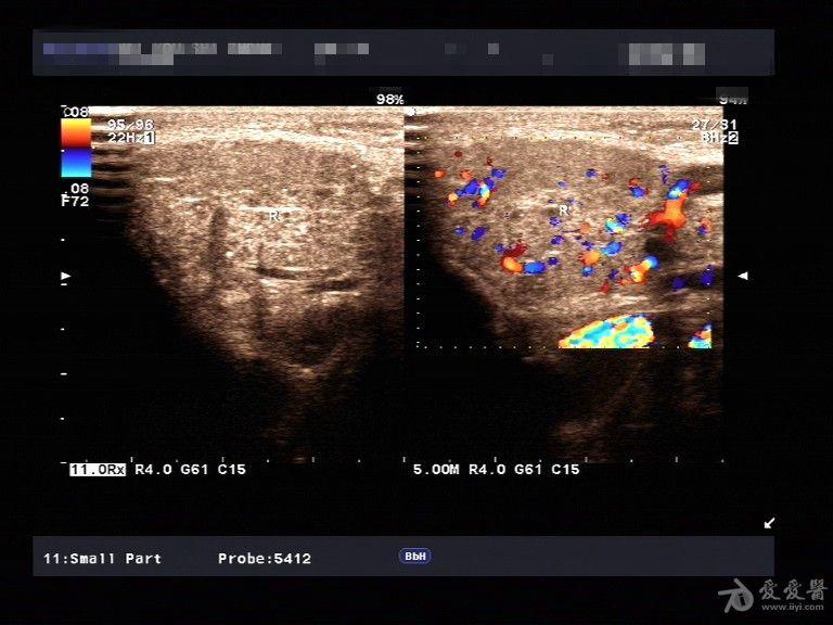 急性腮腺炎的超声图片图片