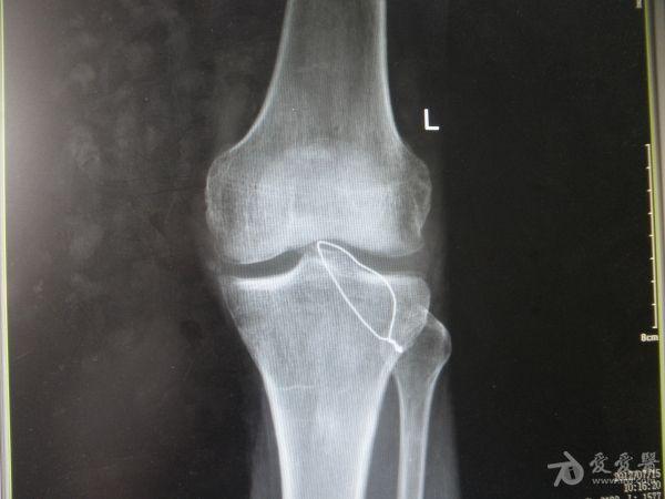 活动受限一天入院,入院诊断为:左胫骨髁间棘撕脱骨折,但移位不明显,可