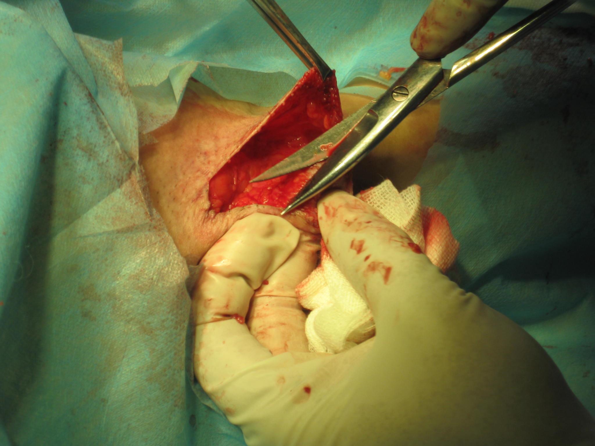 改良腋臭大汗腺切除术