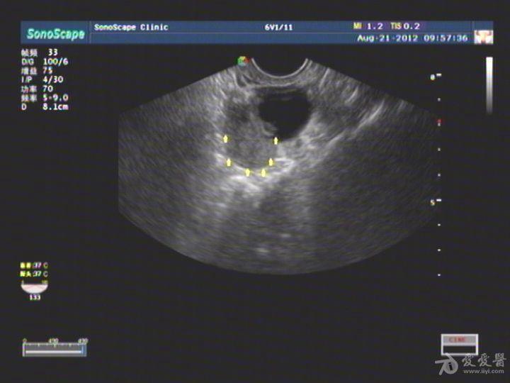 残角子宫超声图图片