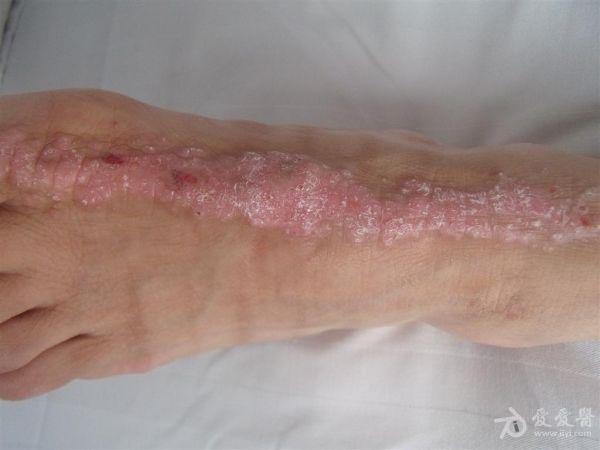 看图诊断---答案已给出---汗孔角化症!