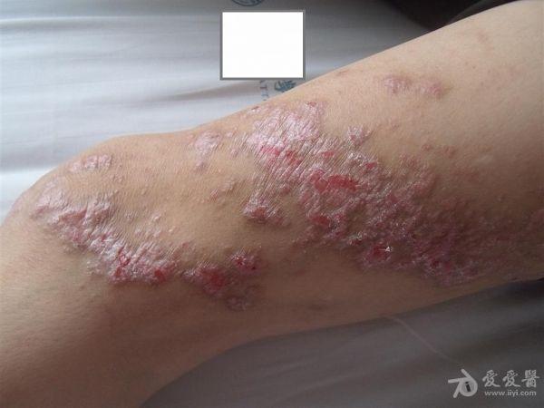 看图诊断---答案已给出---汗孔角化症!