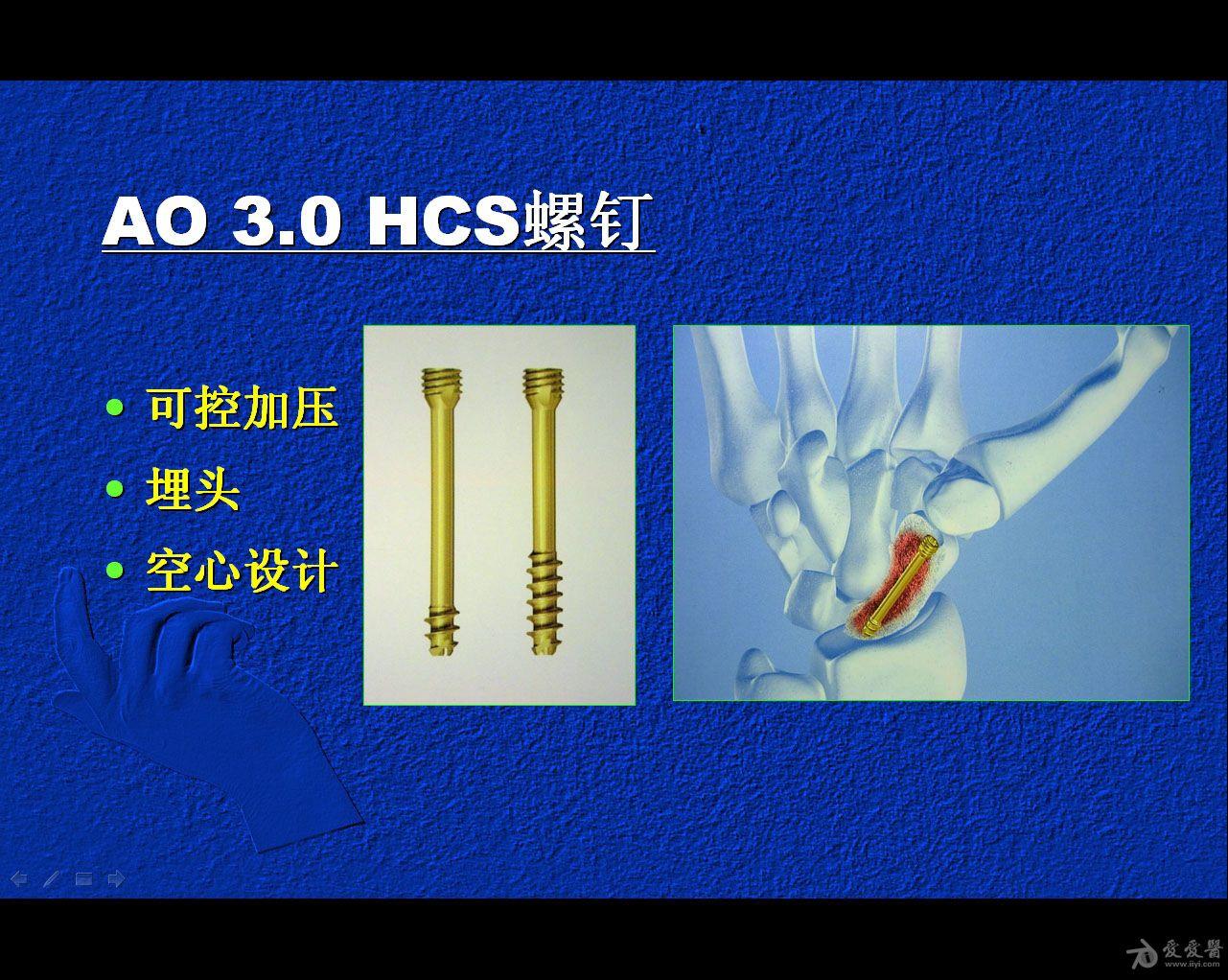 闭合复位经皮埋头空心螺钉 治疗腕舟骨骨折【50期读片会】 - 骨科与