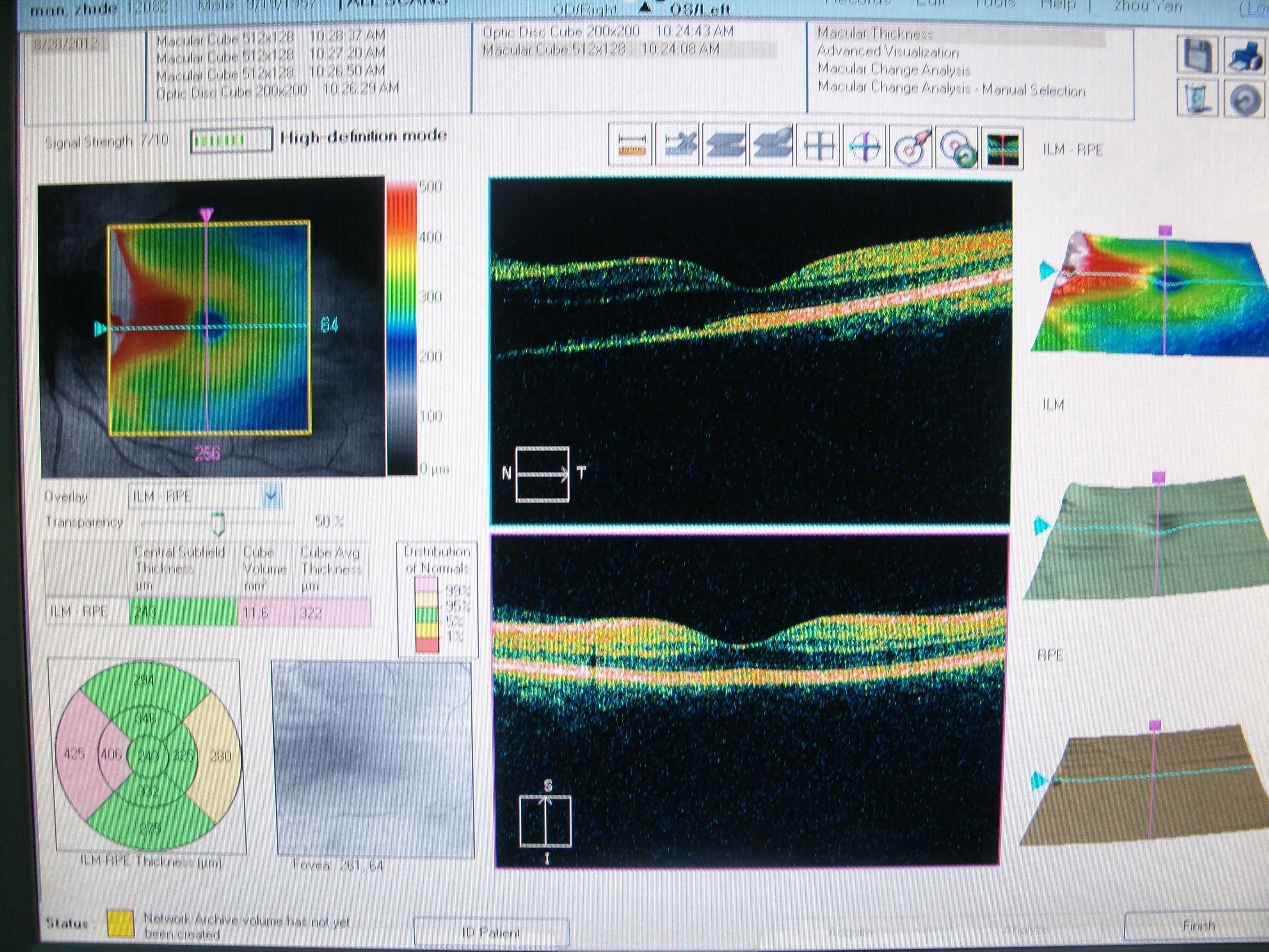 oct黄斑厚度图正常范围图片