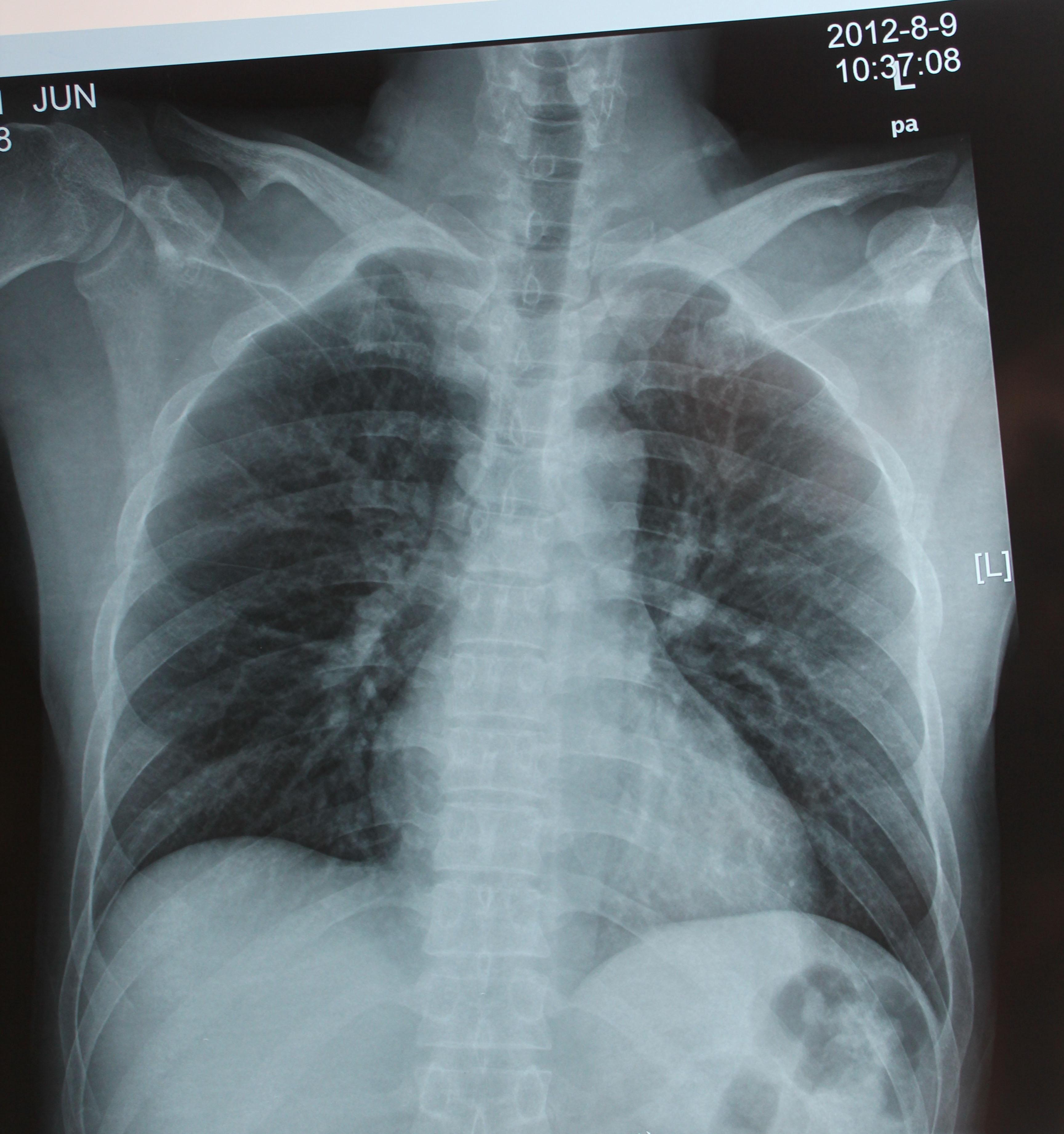 哮喘x线图片图片