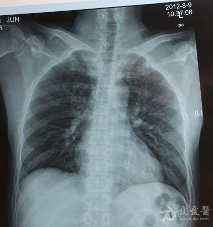 支气管炎发作,近一月没有好,怎么办?