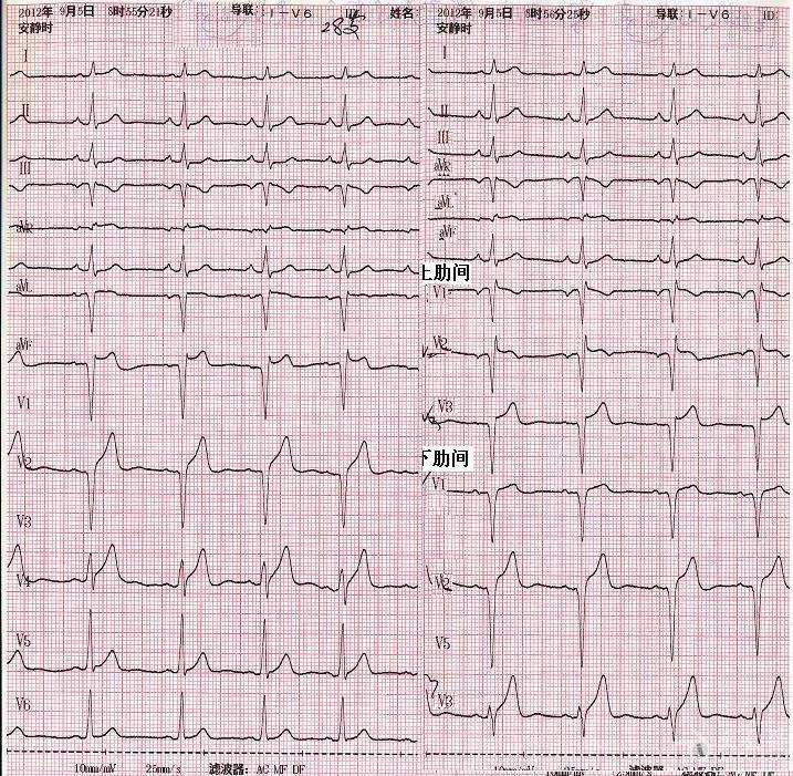 v1-v3呈qs型如何解释?