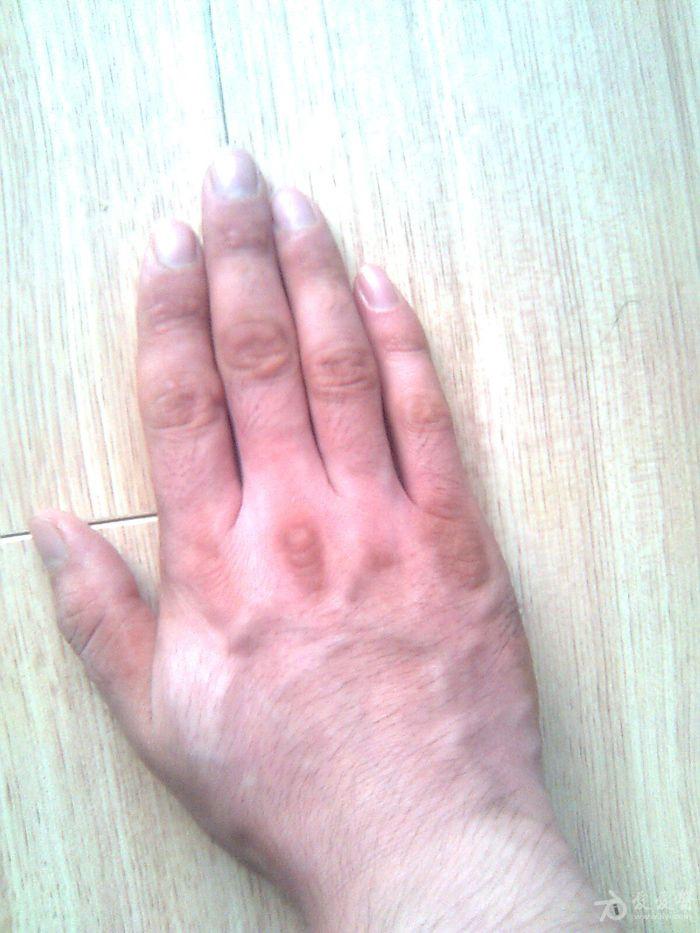 停药后,手部有皴裂脱屑,用中药肤疾洗剂和青鹏软膏外加硅油膏10