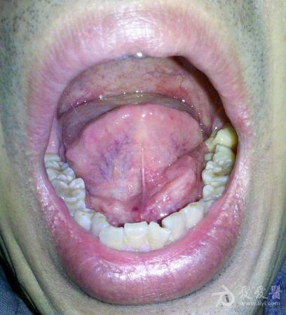 舌下癌图片凸起图片