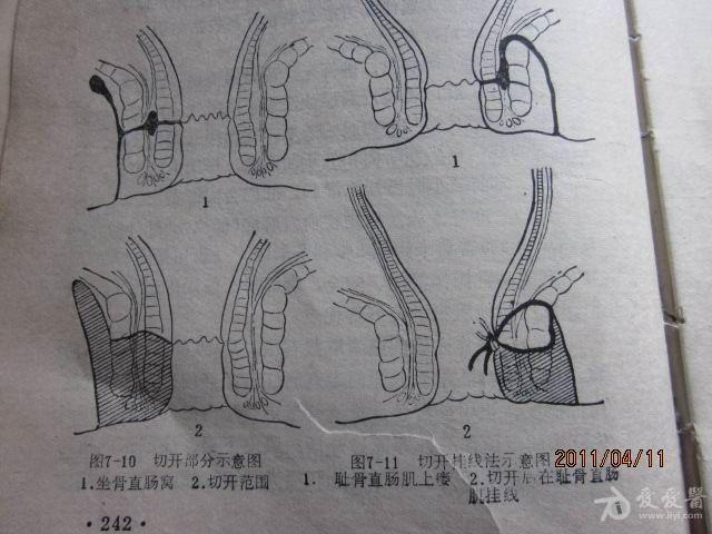 肛瘘挂线手术示意图图片