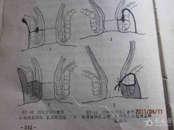 复杂肛瘘手术挂线图图片