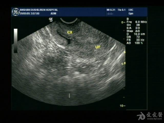 宫颈管积液,是什么原因呢