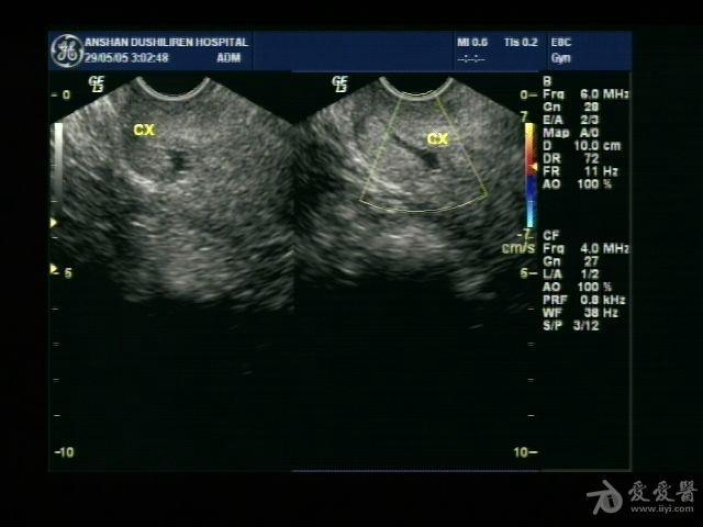 宫颈管积液,是什么原因呢