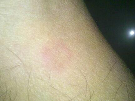 高手请赐教 - 皮肤及性传播疾病讨论版 - 爱爱医医学论坛 - 爱爱医