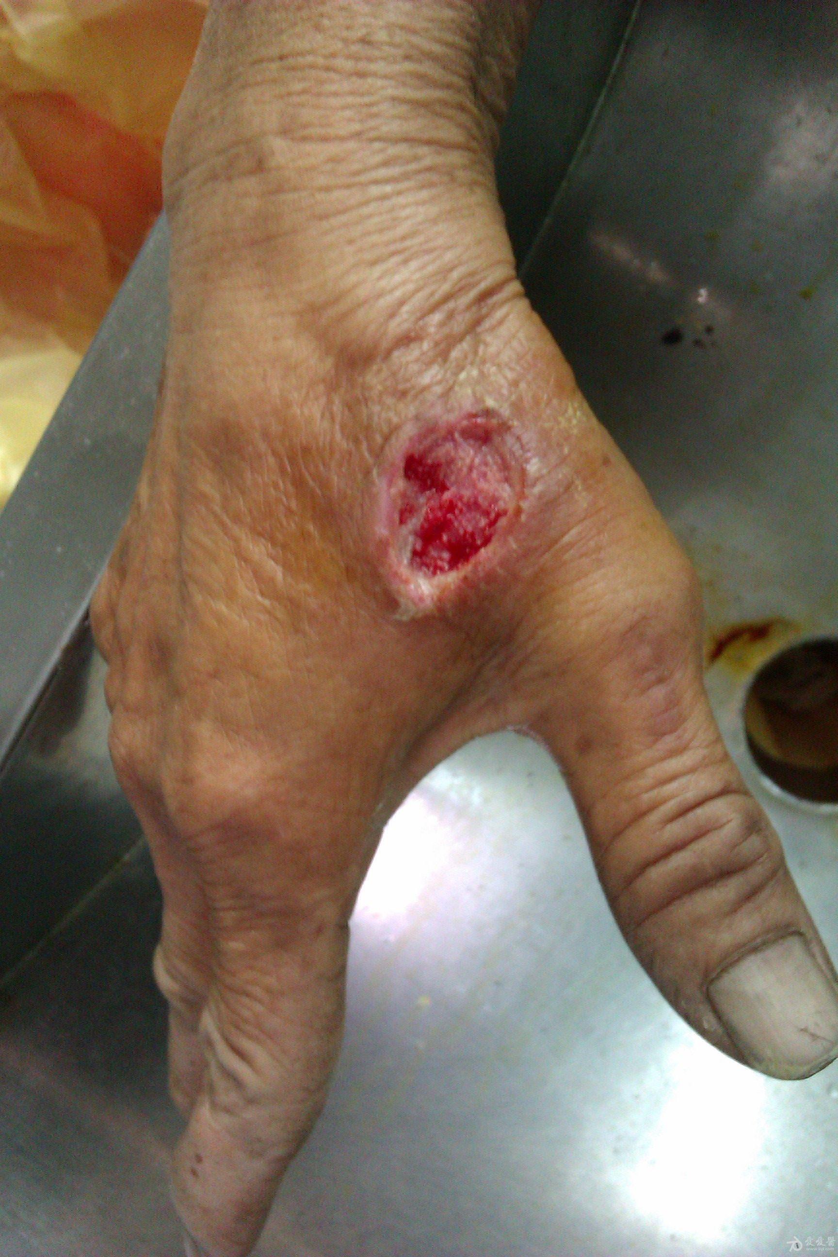 虎口区皮肤缺损