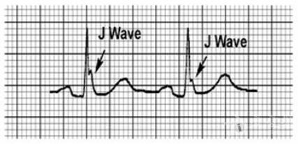 洪葵:j波和epsilon波的识别和临床意义 - 心血管内科讨论版 - 爱爱医