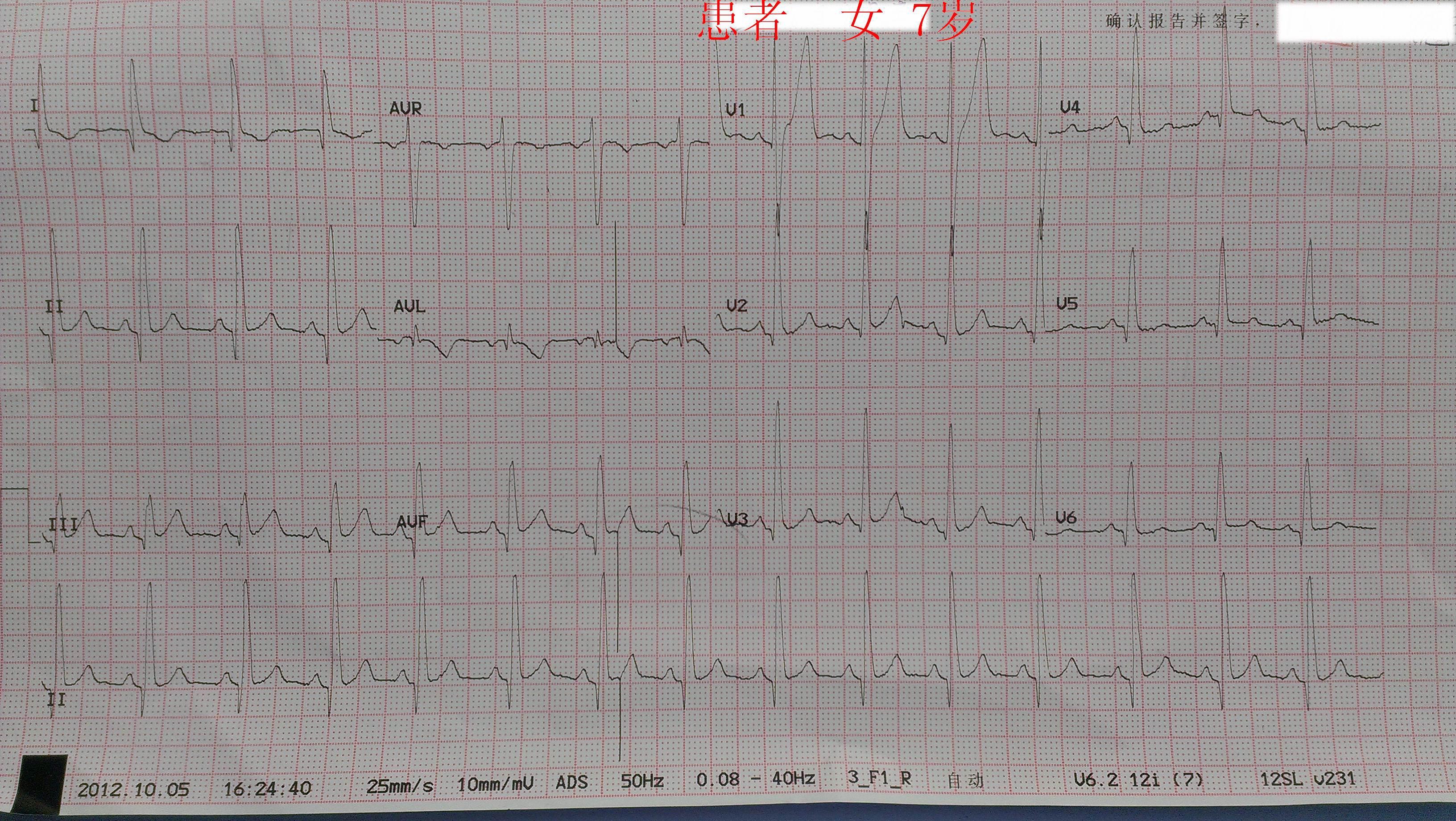 讨论心电图(7岁先心病)——更新心彩报告
