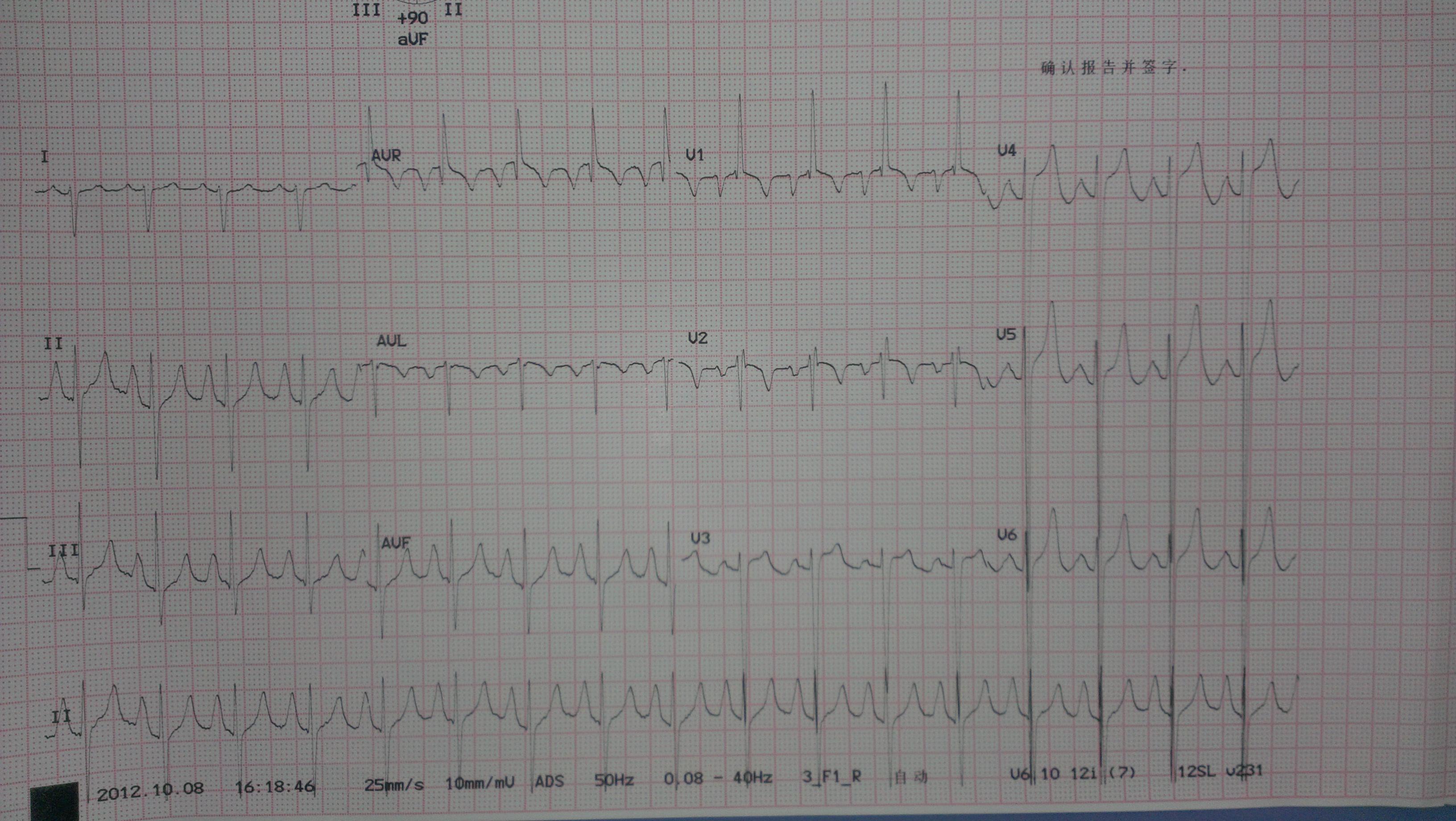 欣赏心电图(双房右室大)