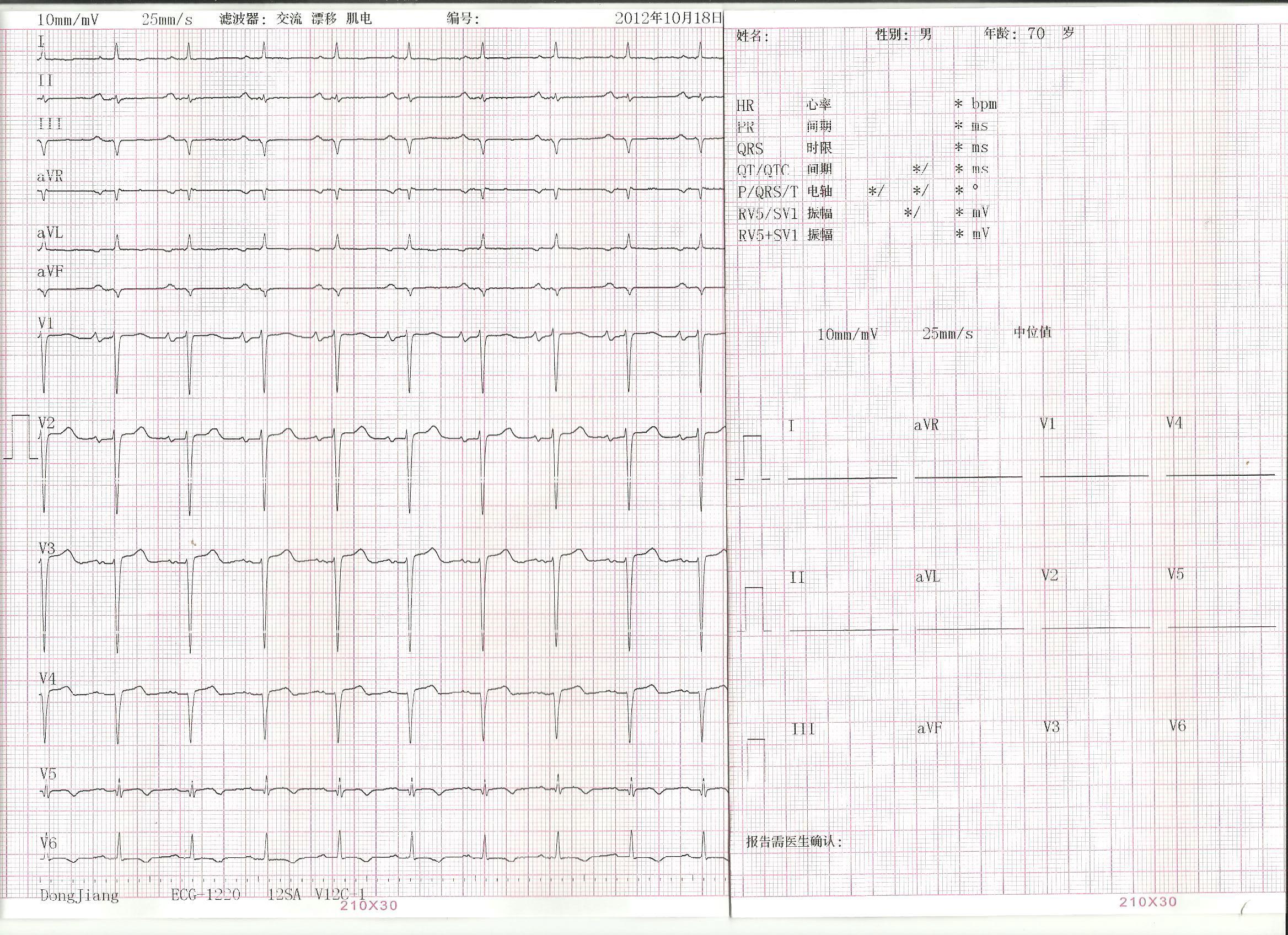 十二导联心电图 标准图片