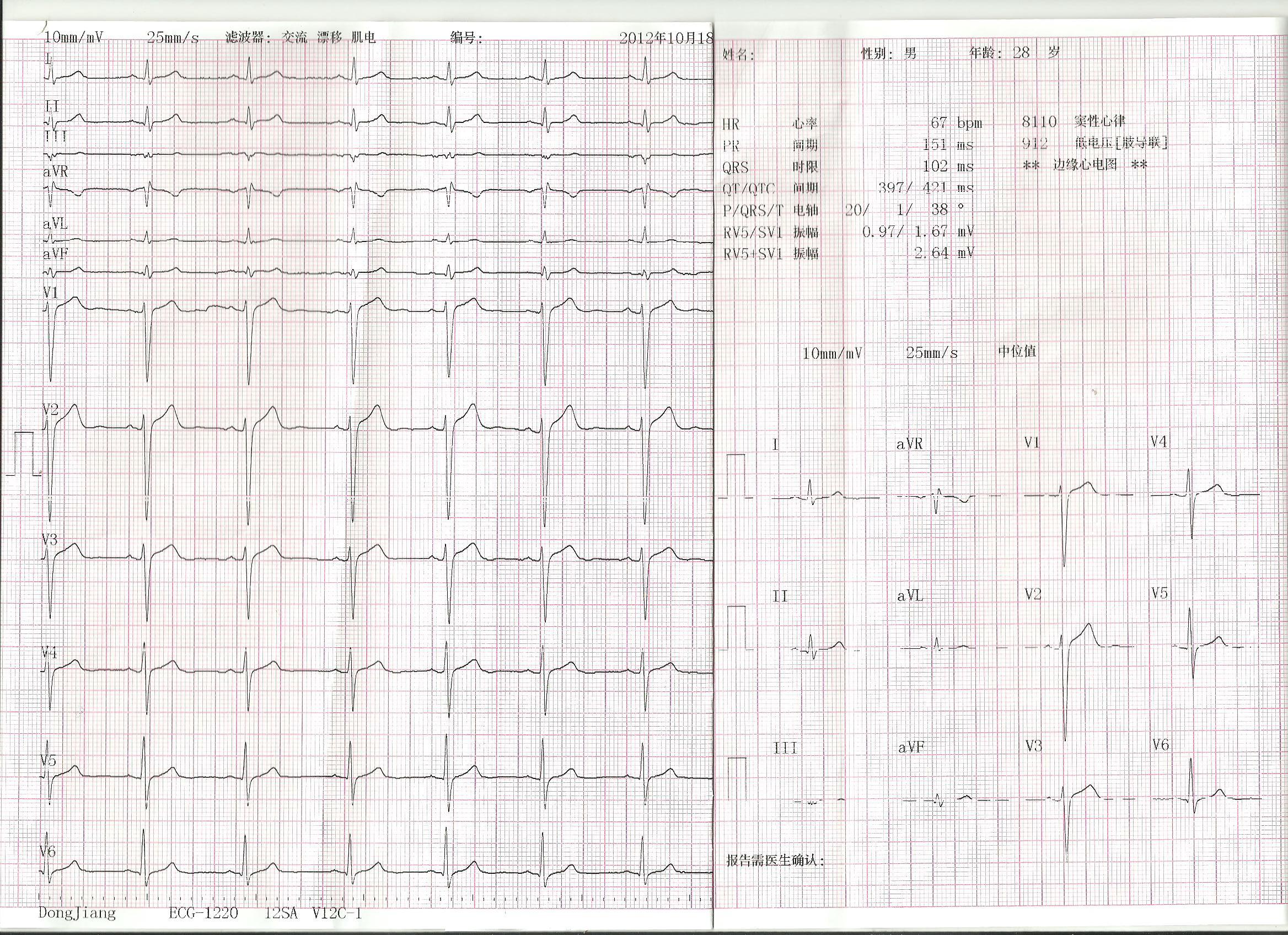 十二导联心电图 标准图片