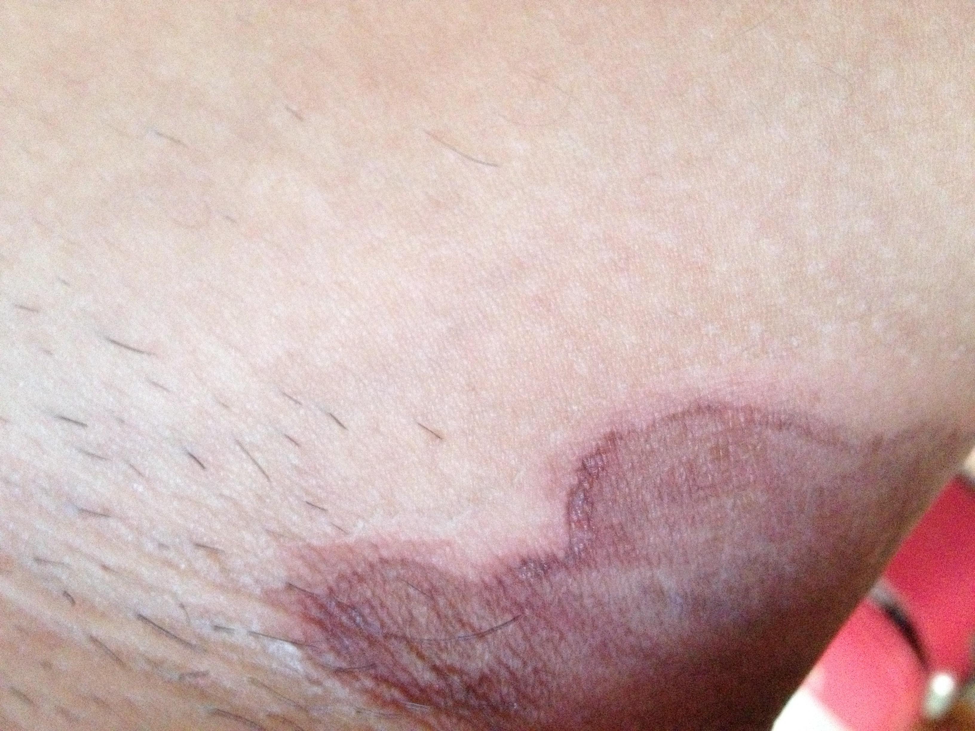 顽固性股癣上图求帮助