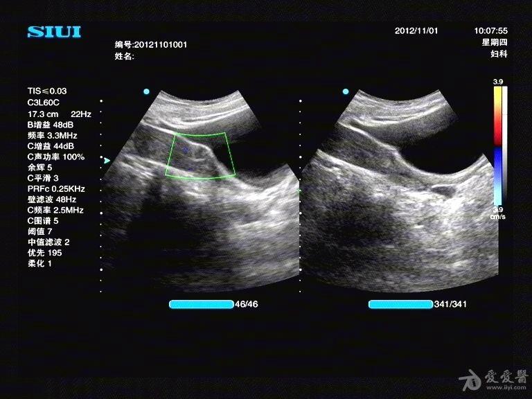 子宫疤痕超声图片图片