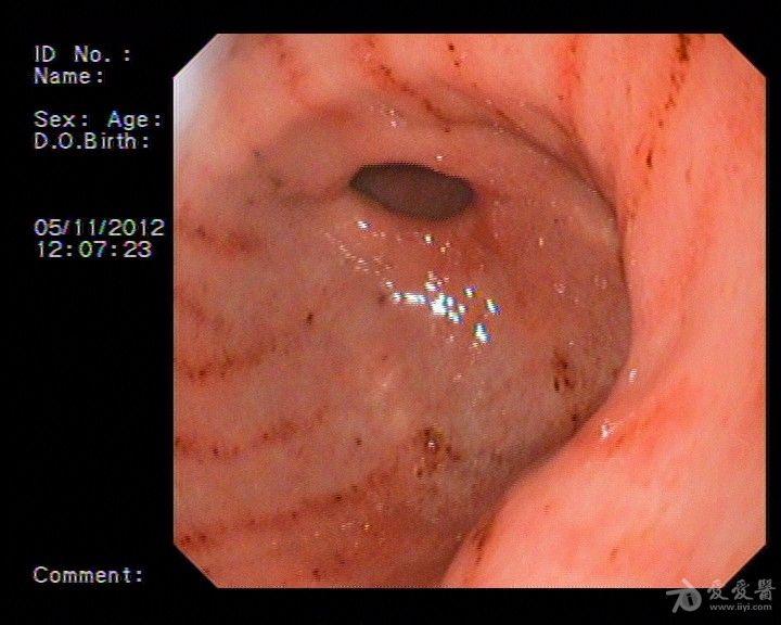 胃窦正常胃镜显示图片图片