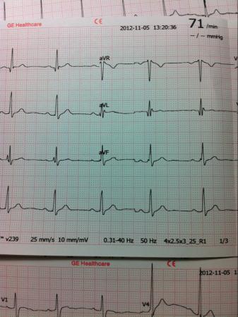心室预激心电图图片