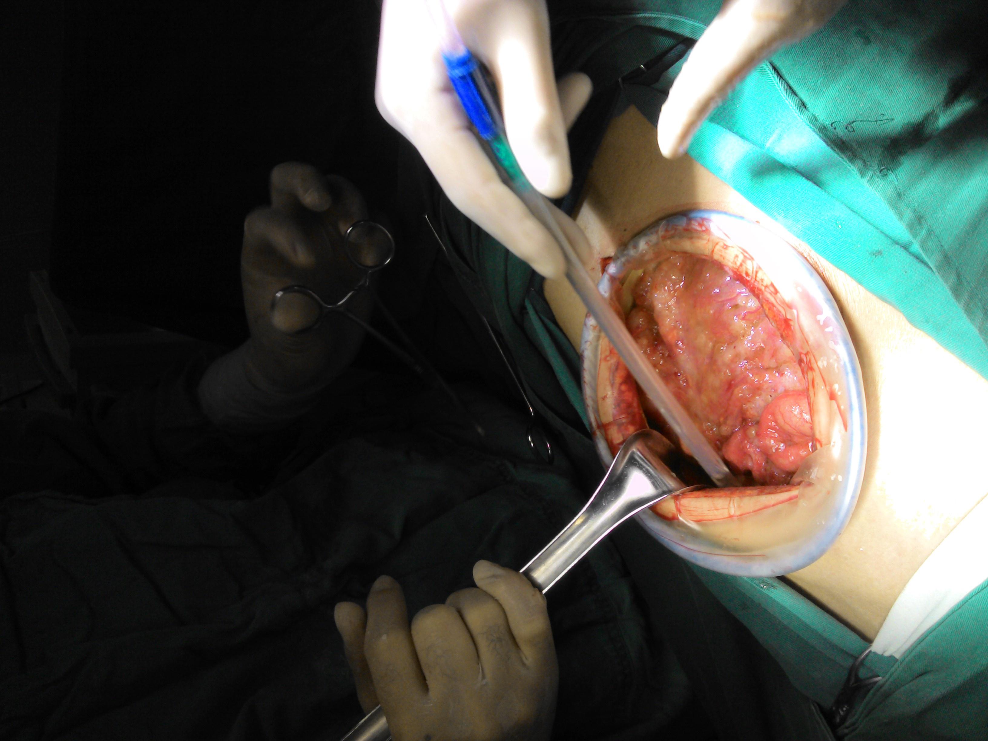 分享一例回盲部肿瘤病例