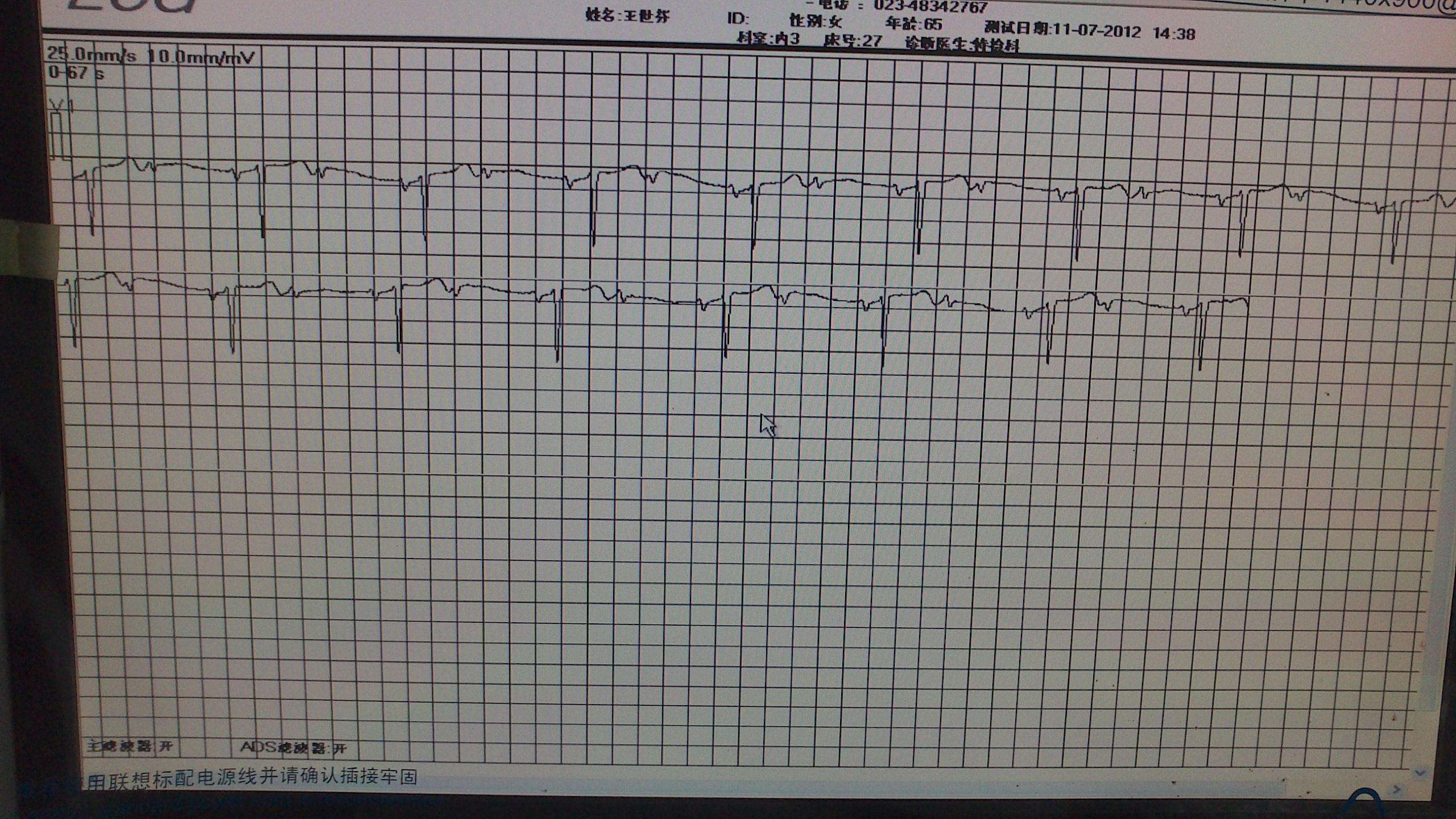 在线等  窦性心律,心室率48bpm;二度ii型房室传导阻滞(2:1);左室肥厚