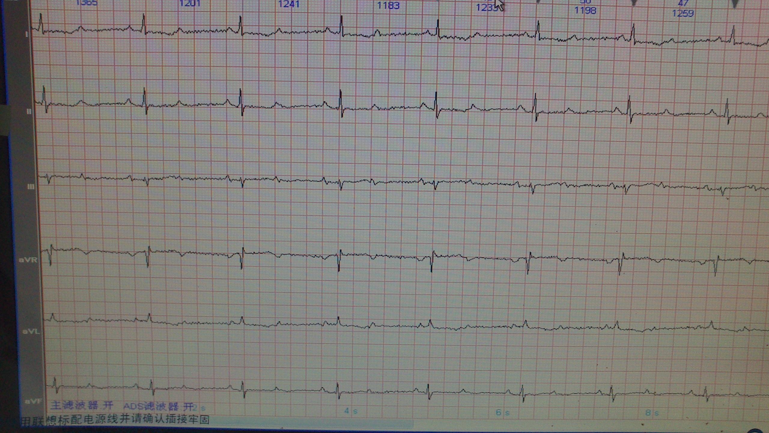 在线等  窦性心律,心室率48bpm;二度ii型房室传导阻滞(2:1);左室肥厚