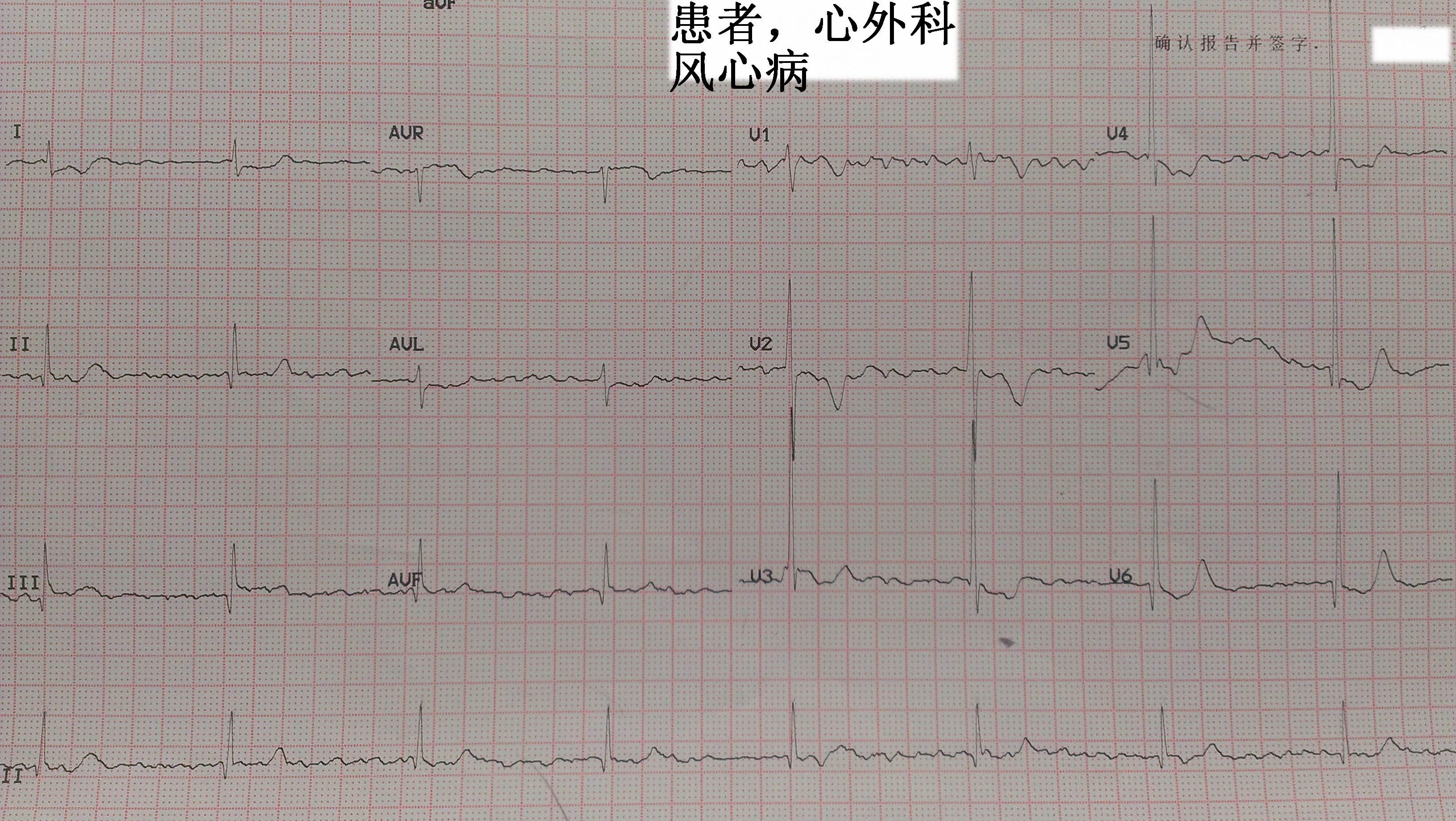 风湿性心脏病心电图图片