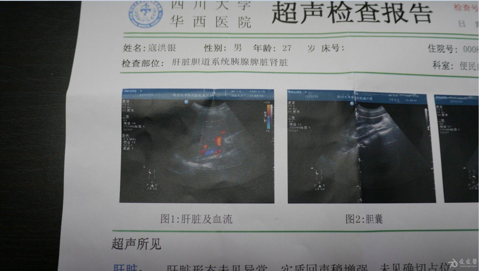 獭尾肝超声图片