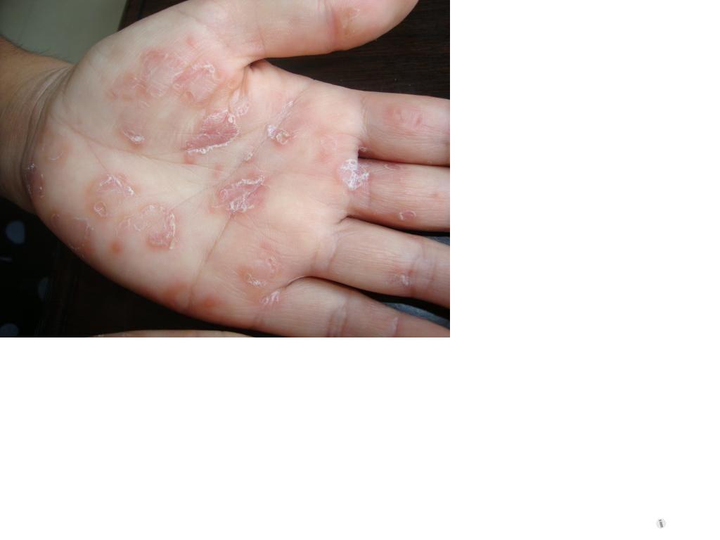 二期梅毒症状图片图片