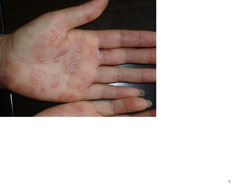梅毒二期一期梅毒图片
