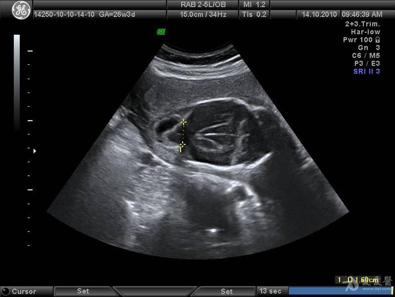 一组婴儿型多囊肾图像加引产后图片