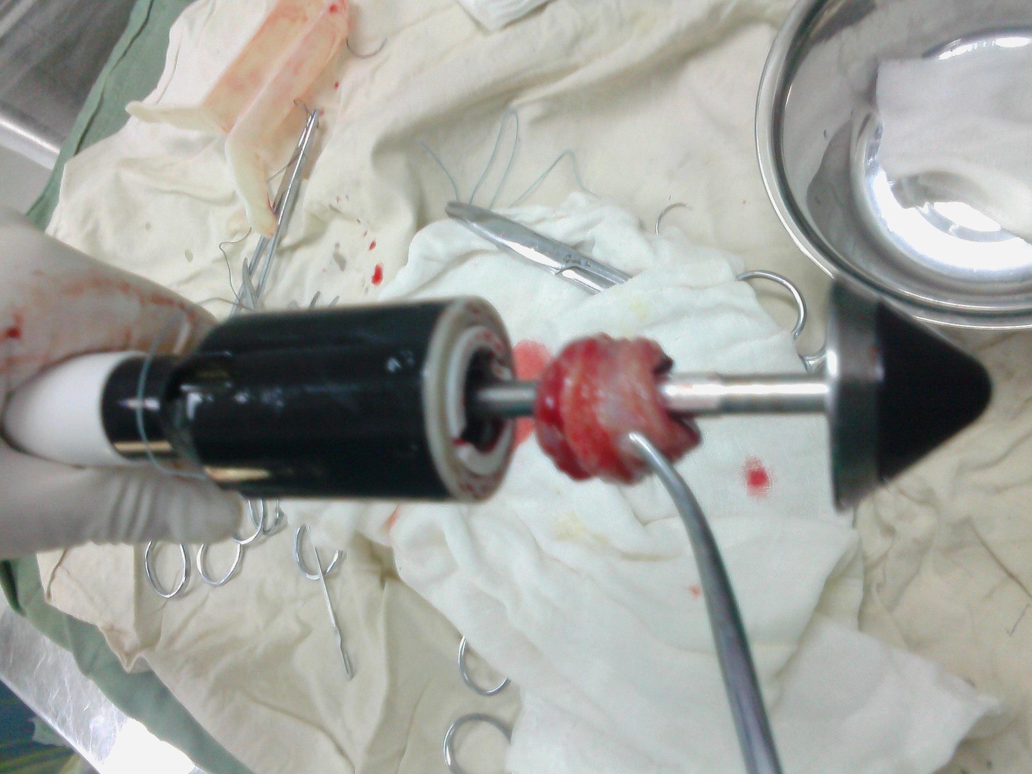 楼主舒适2012-11-21 12:37:53             患者 男性 73 岁 肛门肿物