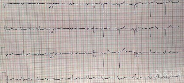 慢性肺心病心电图图片