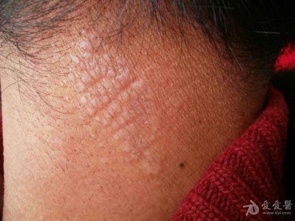 病例分享:神经性皮炎.