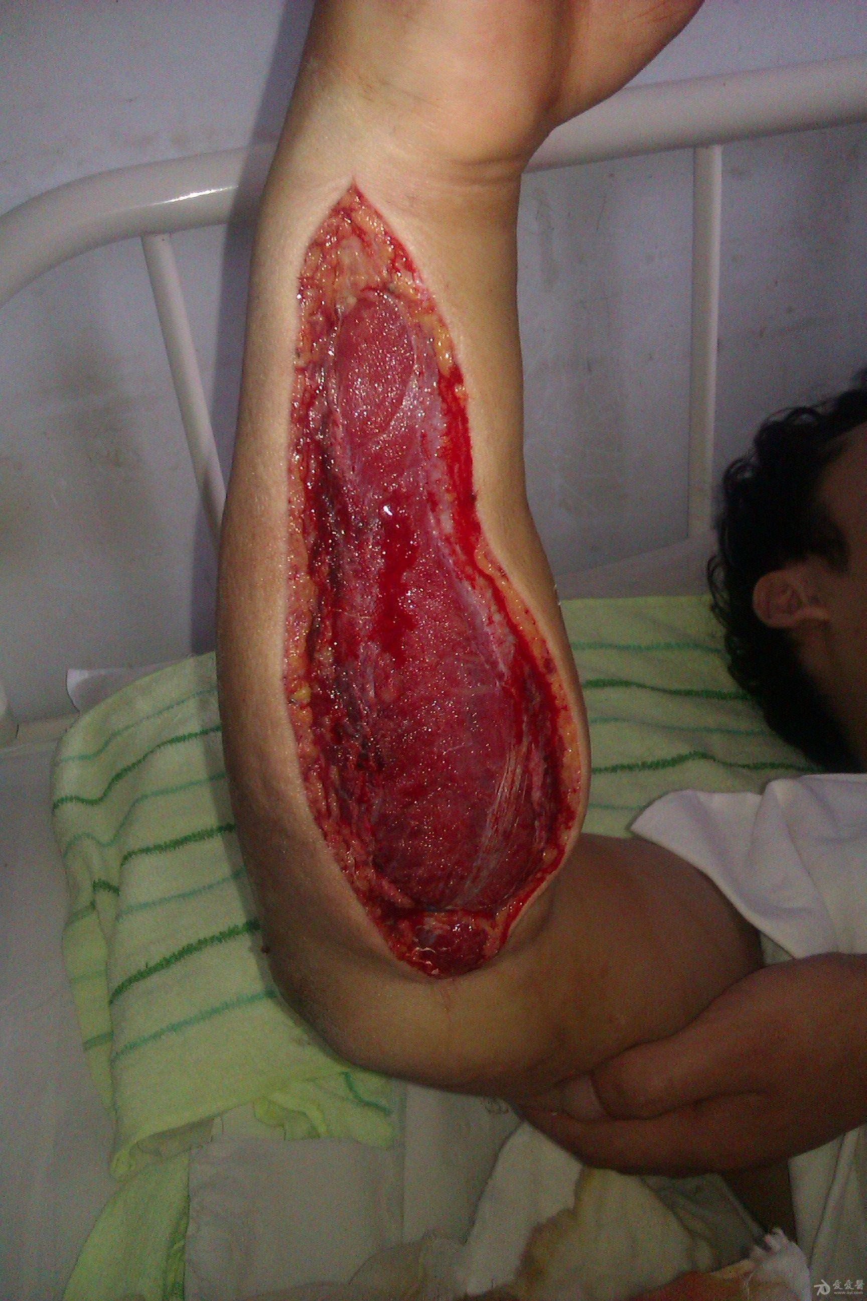 前臂旋转挤压伤伴尺桡骨骨折