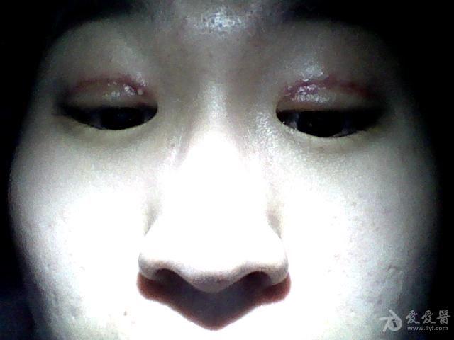 重睑切割术后拆线一周一针眼处长白疙瘩周围发红(图片)急!