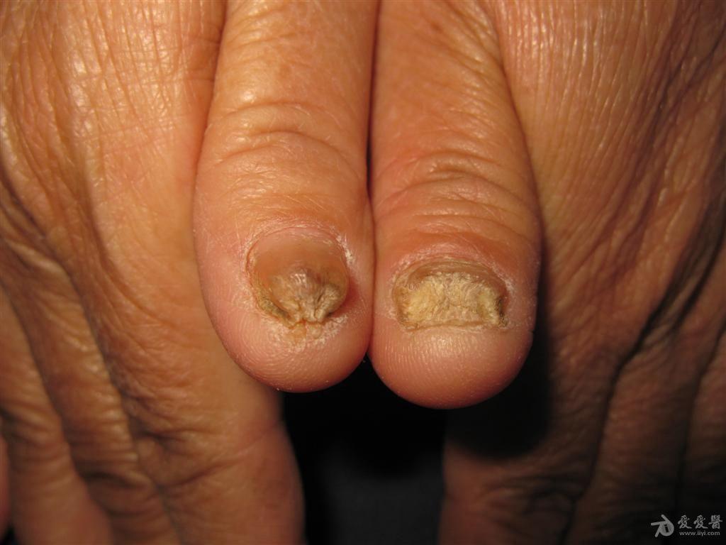 这是什么皮肤病?-------厚甲症