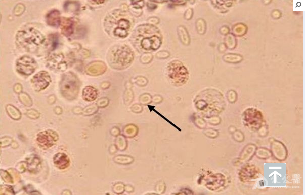 (白带常规) 显微镜下的霉菌是怎样的?