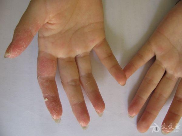 2例女性手指曲面干燥,鳞屑.