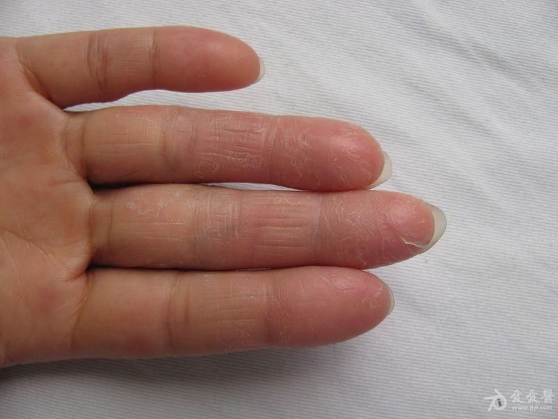 手指皮肤角化症角质图片
