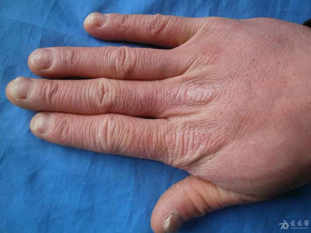 请你诊断:答案:手癣.经查真菌( ).