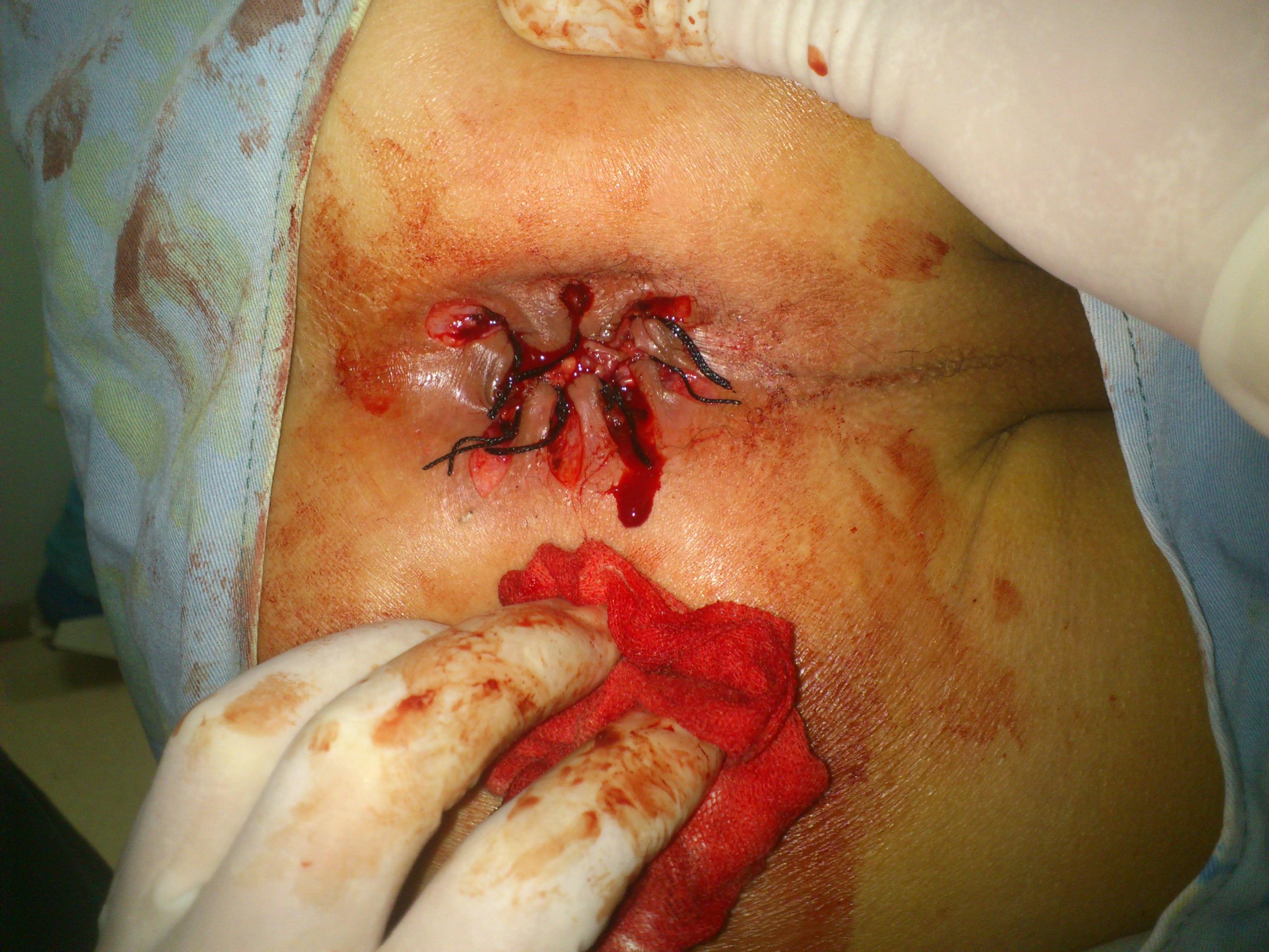 像盛开的向日葵一样的大环痔